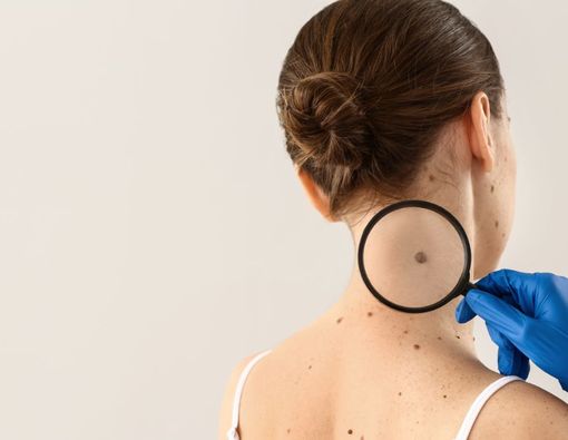 Macam-Macam Tanda Lahir dan Kenali Peringatan Bahayanya