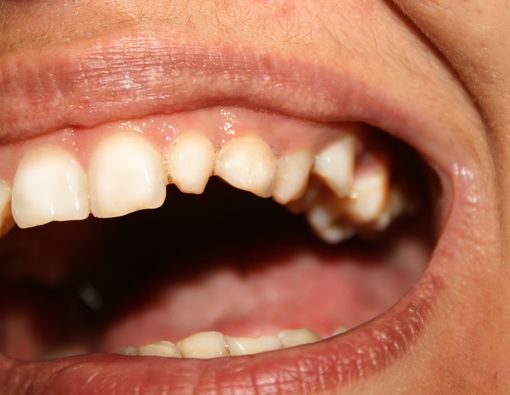 Bisakah Membuat Gigi Gingsul Secara Alami?