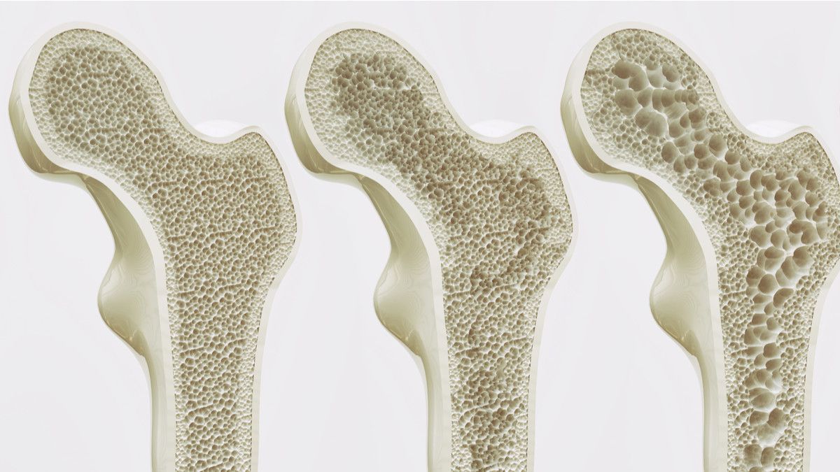 Osteoporosis, Penyakit Orang Tua yang Bisa Dicegah Sejak Muda