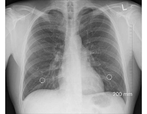 Patah Tulang Rusuk Bisa Picu Sesak Napas, Ini Penyebabnya
