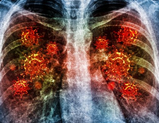 Waspada Bahaya Community-Acquired Pneumonia di Masyarakat