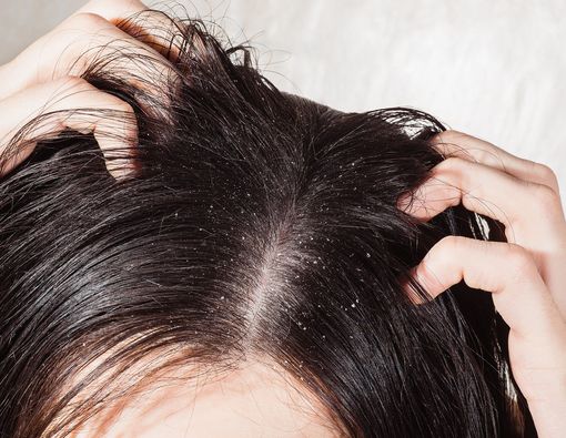 5 Penyebab Ketombe yang Tidak Anda Duga