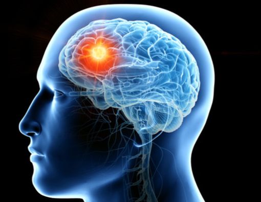 Tanda Tumor Otak Mengintai Anda