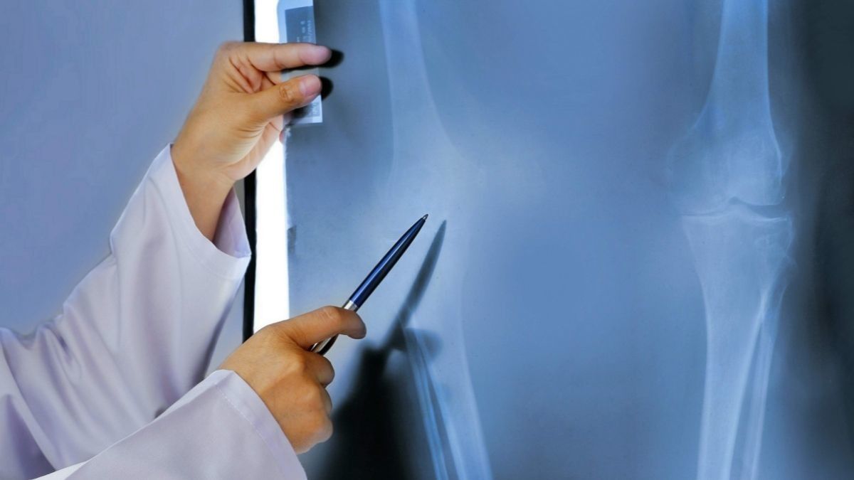 Metode-Metode untuk Mendiagnosis Kanker Tulang