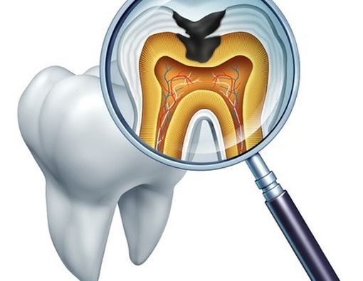 Mitos dan Fakta Tentang Gigi Berlubang