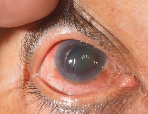 Mengenal Kondisi Glaukoma yang Bisa Sebabkan Kebutaan