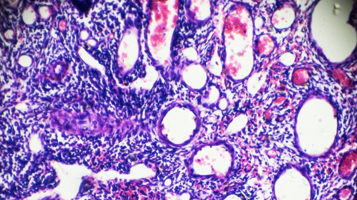 Mengenal Polip Serviks, Tumor Jinak yang Tumbuh di Leher Rahim