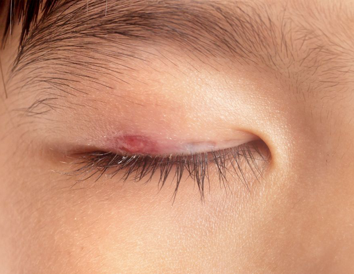 5 Pilihan Obat Mata Bintitan yang Efektif