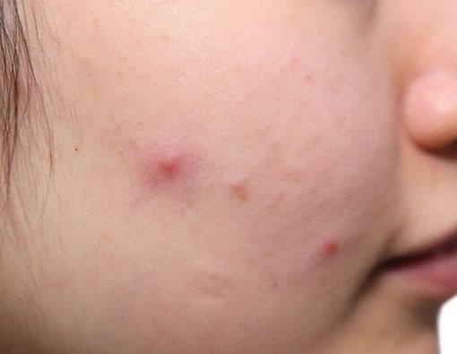 Mengatasi Jerawat dengan Aseton, Aman atau Tidak?