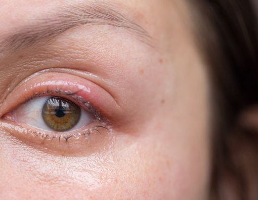 3 Kebiasaan Sepele Penyebab Mata Bintitan