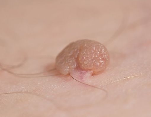 Mengenal Perbedaan Kutil Kelamin dan Herpes Genital