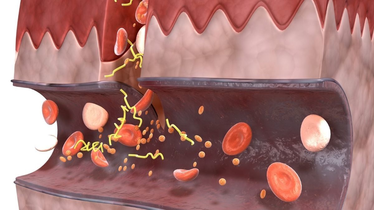 Pemicu Kerusakan Pembuluh Darah Pengidap Diabetes Tipe 2