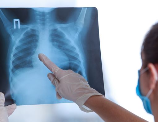 4 Jenis Pneumonia yang Harus Kamu Ketahui, Apa Saja?