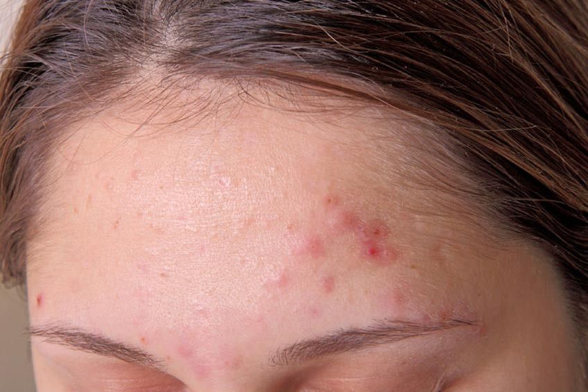 Sudah Tua Kok Masih Jerawatan?