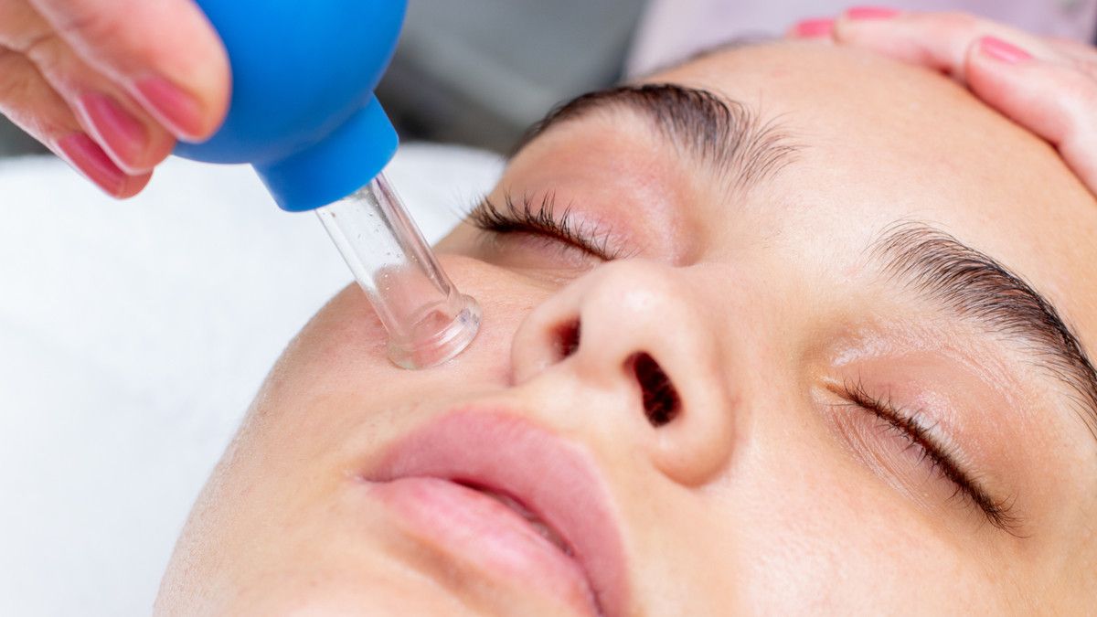 Menyingkap Manfaat Bekam untuk Jerawat