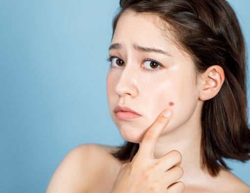 Jerawat Bisa Picu Depresi, Ini Faktanya