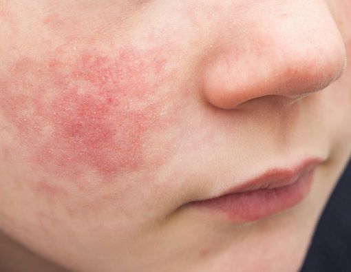 Cara Menghilangkan Eksim di Wajah yang Aman dan Efektif