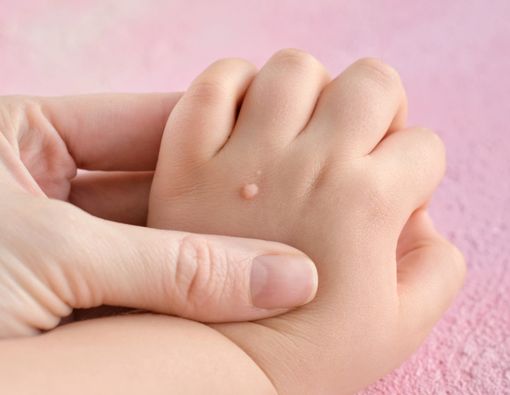 Penyebab dan Cara Mengatasi Kutil di Tubuh Anak