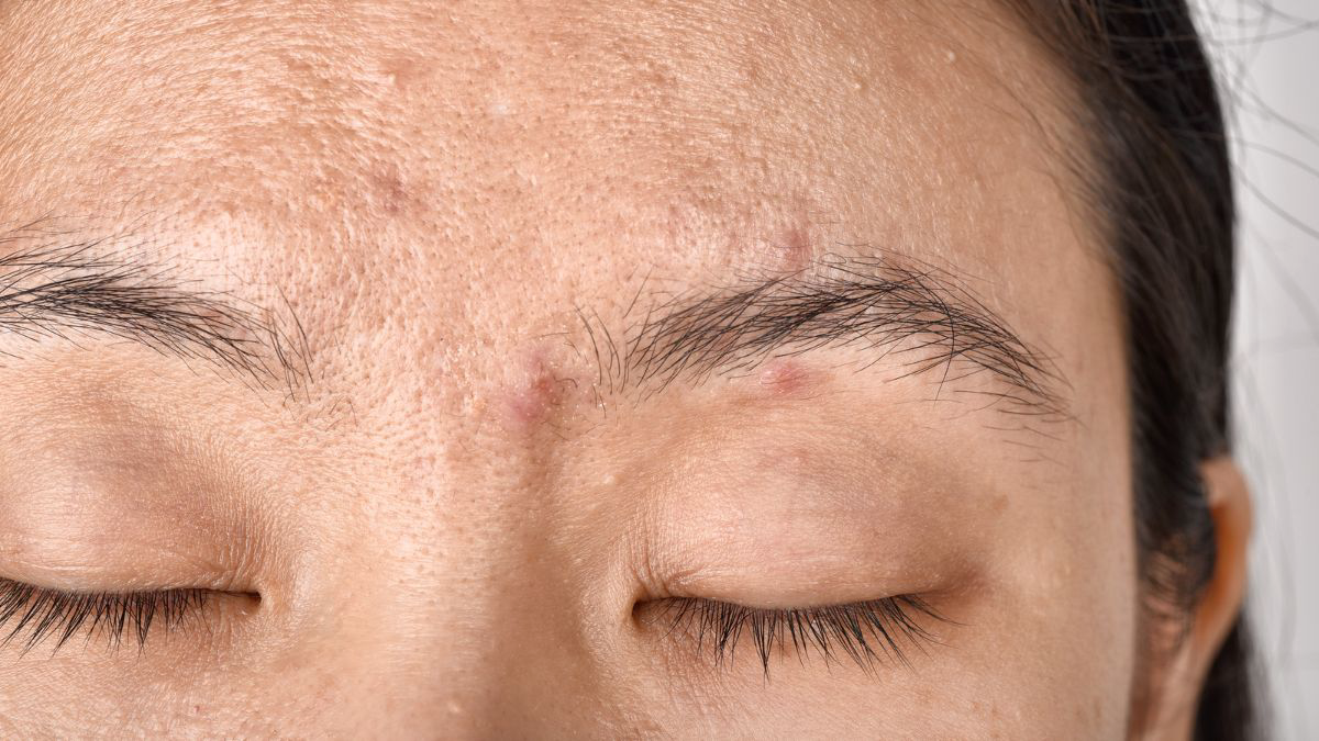 Risiko Efek Samping Dermaroller