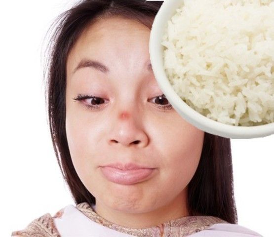 Nasi Putih Bisa Sebabkan Jerawat!