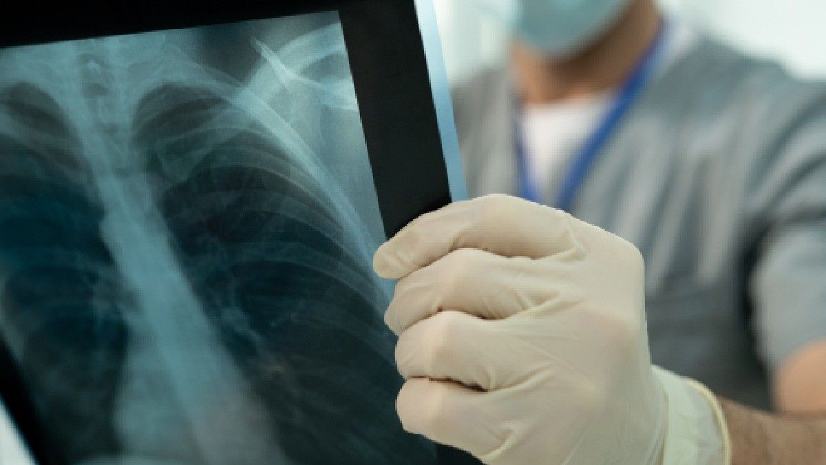 Mengenal Operasi Kanker Paru Segmentectomy Beserta Efek Sampingnya