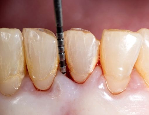 Gejala Periodontitis yang Harus Kamu Waspadai