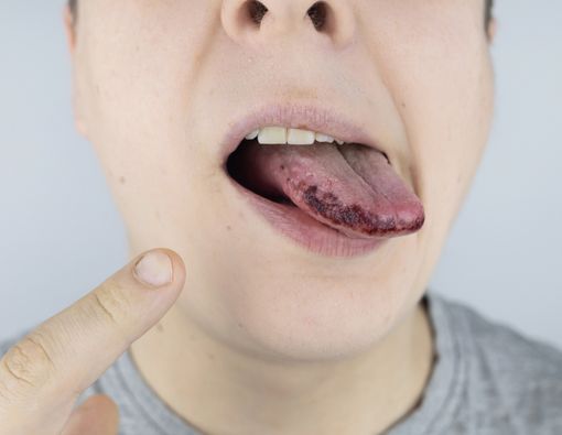7 Penyebab Lidah Menghitam dan Berbulu, Berbahayakah?