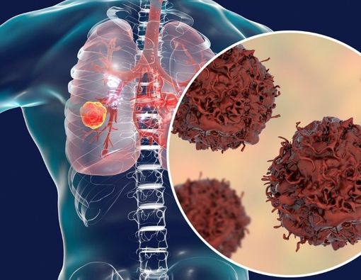 Kanker Paru Sel Kecil dan Gejalanya yang Mesti Diwaspadai