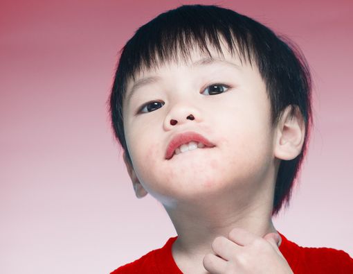 Alergi Susu Sapi, Apakah Anak Tidak Bisa Minum Susu Sama Sekali?