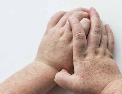 Waspada Demam Scarlet, Ini Gejalanya!