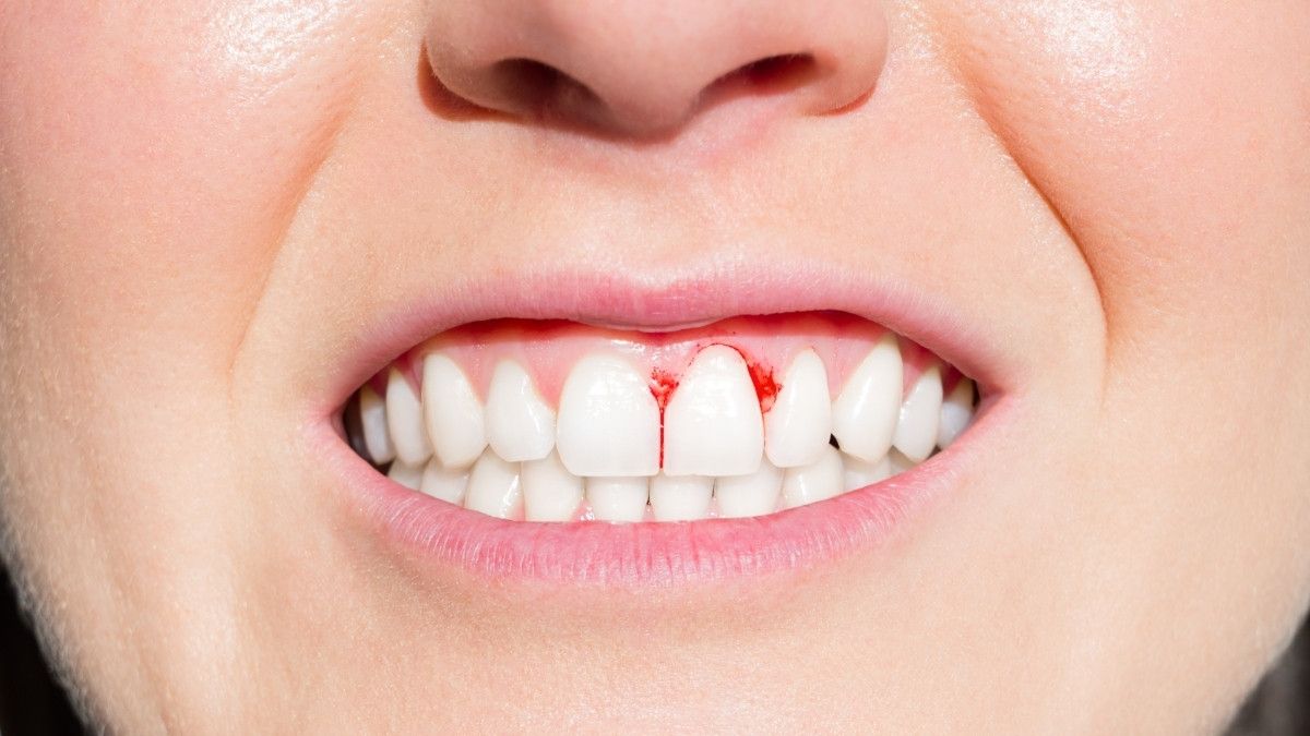 Ini Perbedaan Gingivitis dan Periodontitis