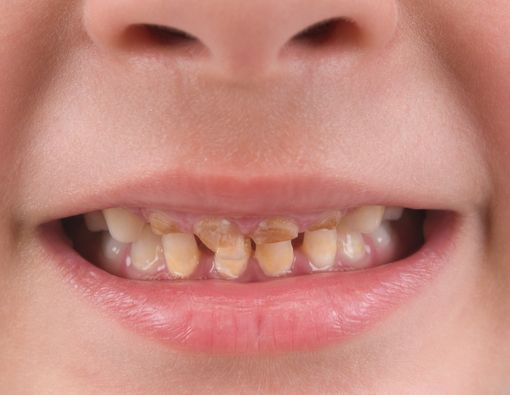 Penyebab Gigi Kuning pada Balita dan Cara Mengatasinya