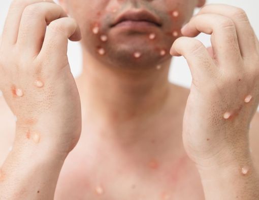 7 Gejala Cacar Air yang Perlu Diwaspadai