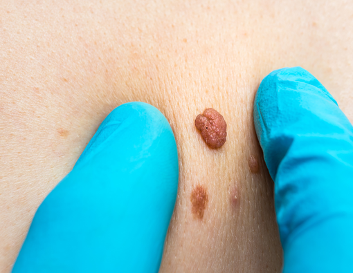 Skin Tag