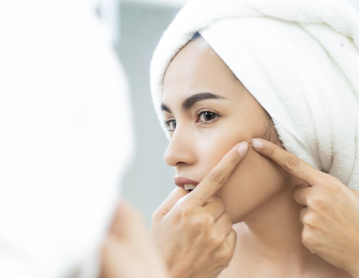 Serba-Serbi Acne Prone Skin, Kondisi Wajah Rentan Berjerawat