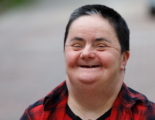 Mengenal Sindrom CLOVES, Dari Gejala hingga Pengobatan