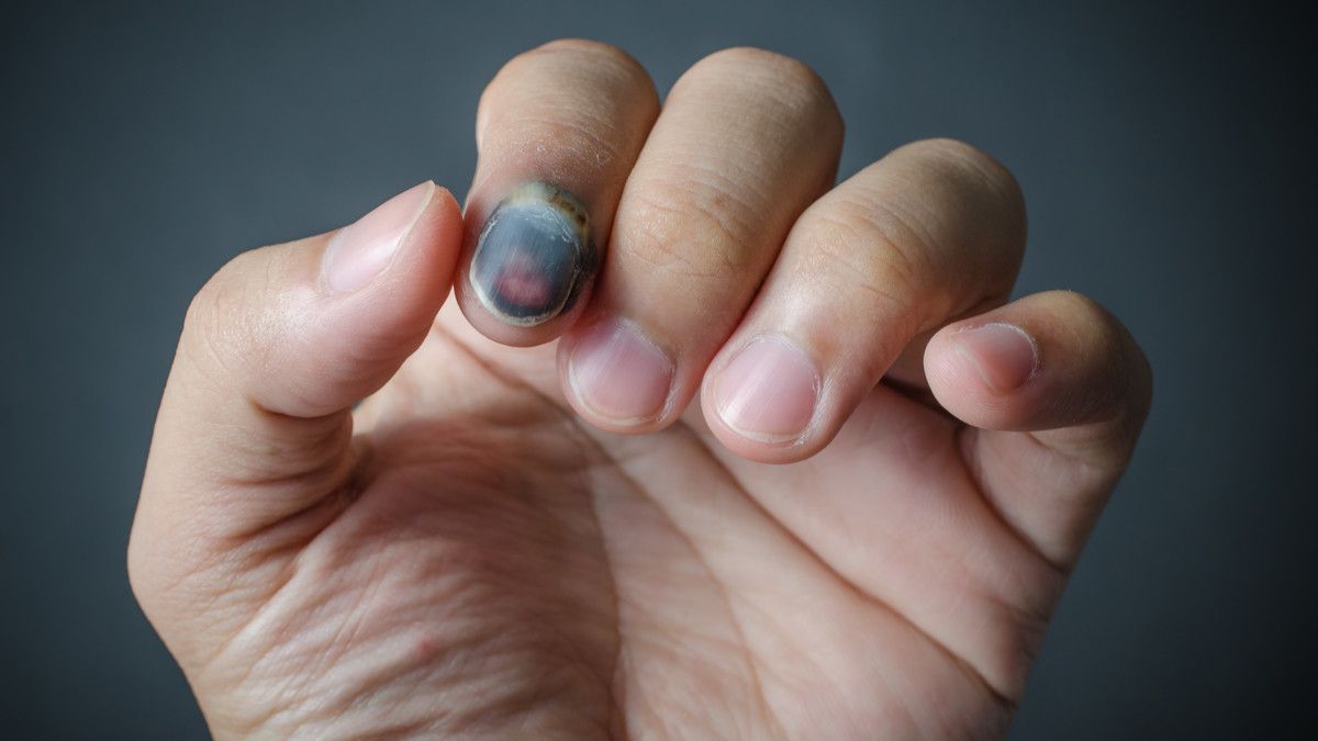 Kuku Jadi Biru karena Terjepit, Apa yang Harus Dilakukan?