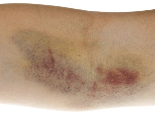 Arti Warna Memar pada Tubuh Anda