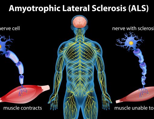Seluk Beluk Penyakit ALS yang Diidap Pencipta SpongeBob