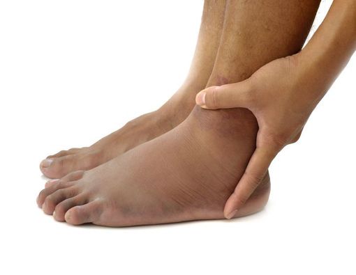 Baca Kondisi Kesehatan Anda dari Bagian Tubuh yang Bengkak