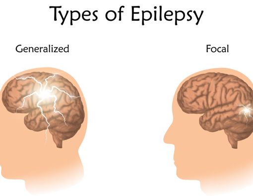 Sering Epilepsi Menandakan Gejala Kanker Otak?