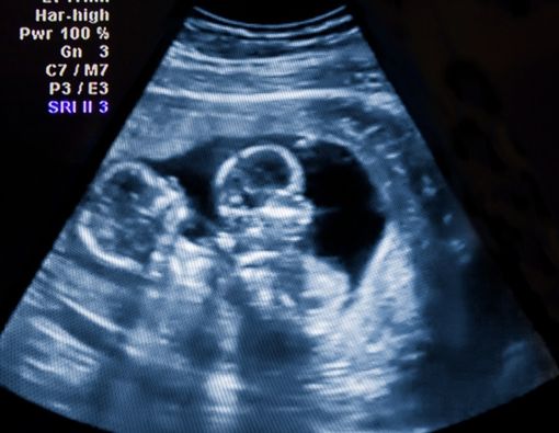 Bisakah Punya Anak Kembar Tanpa Garis Keturunan Kembar?