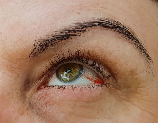 Obat Diabetes Sebabkan Kerusakan Mata, Mitos atau Fakta?