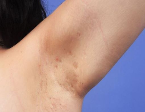 Mengenal Tahapan Penyakit Hidradenitis Suppurativa
