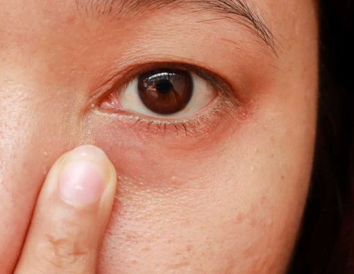 Penyebab Bintik Putih di Kelopak Mata Bagian Dalam