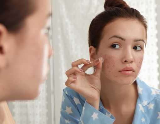 Seberapa Ampuh Stiker Jerawat untuk Wajah? Ini Faktanya!