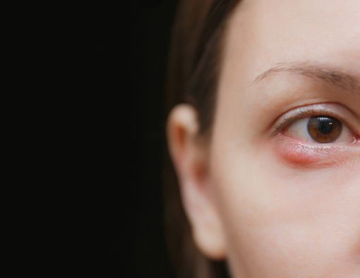 Tips Ampuh untuk Mencegah Bintitan Berulang