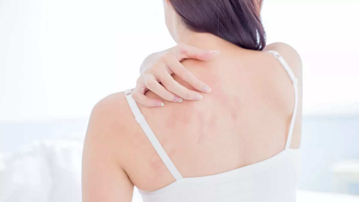 Cara Mengatasi Bekas Gatal Menghitam karena Digaruk