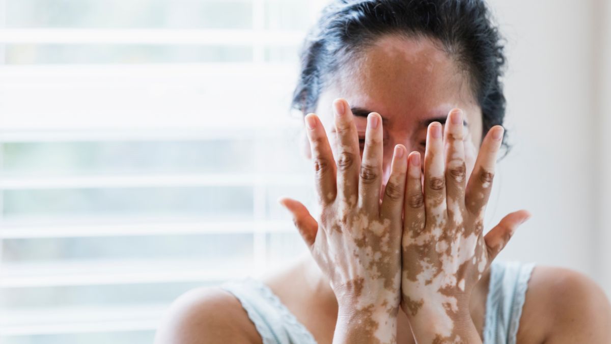 6 Penyebab Vitiligo, Bercak Putih di Kulit