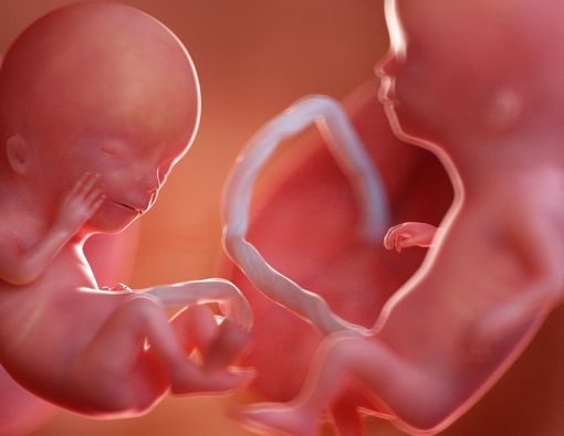 Twin-to-Twin Transfusion Syndrome (TTTS), Sindrom Apa Ini?